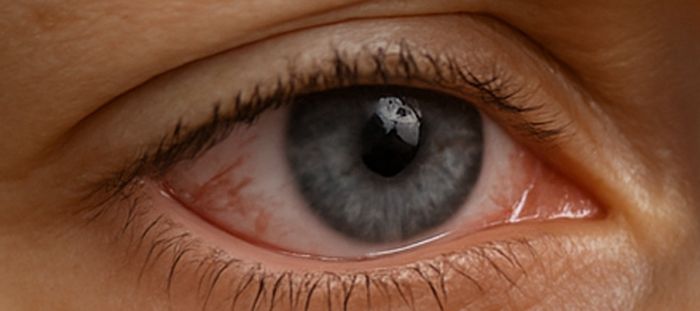 Ojo seco